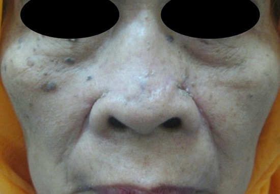 Resultado p&oacute;s-operat&oacute;rio ap&oacute;s 3 meses