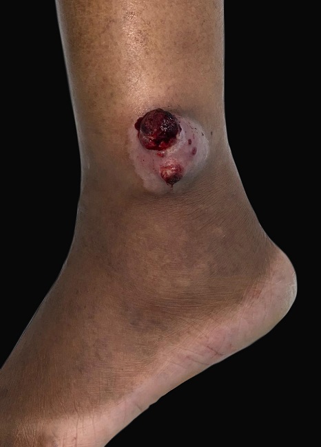 Histiocitoma fibroso maligno. Tumoração acima do maléolo lateral da perna direita