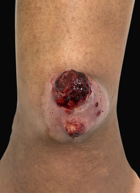 Tumoração de superfície fibrosa, aderida, com limites definidos e áreas friáveis