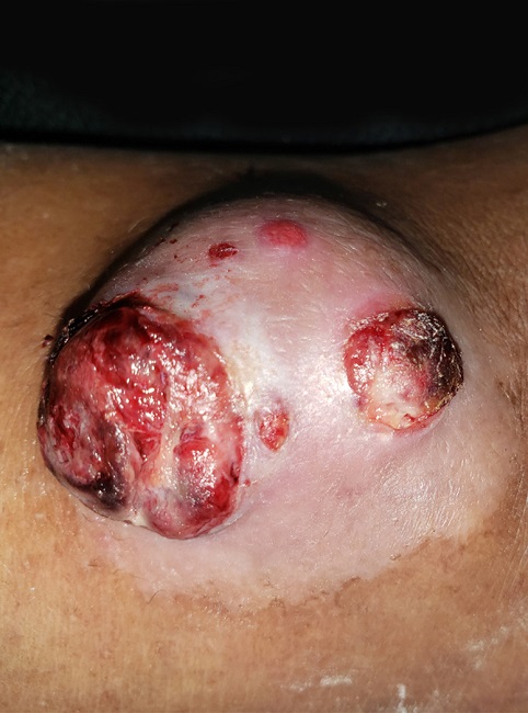 Detalhe da superfície lisa, com pápulas e nódulos friáveis