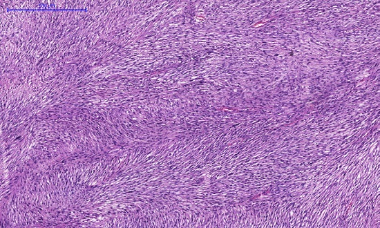Histiocitoma fibroso maligno. Proliferação de células fusiformes, formando feixes curtos, em diferentes direções (Hamatoxilina & eosina, 25x)
