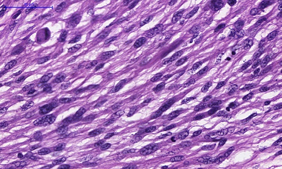 Detalhe dos feixes de células feixes de células fusiformes com intenso pleomorfismo celular e atividade mitótica (hematoxilina & eosina, 100x)