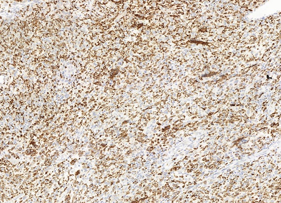 Coloração imuno-histoquímica. Imunomarcação extensa pelo CD68 (histiócitos)