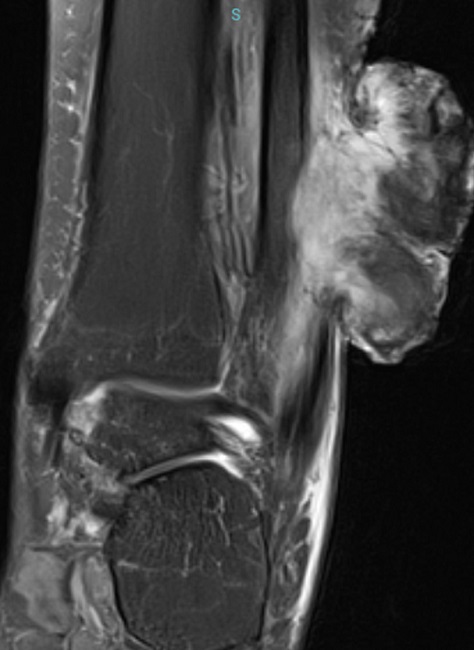 Histiocitoma fibroso maligno. Imagem de ressonância nuclear magnética evidenciando massa vegetante com hipersinal, invadindo a porção distal da fíbula