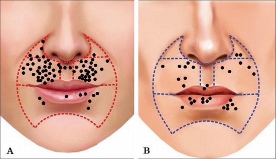 Regi&atilde;o perioral e suas subunidades anat&ocirc;micas. As marca&ccedil;&otilde;es indicam
							os locais dos tumores em mulheres (A) e homens (B)