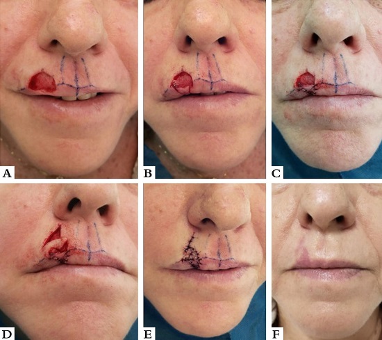 Retalho de transposi&ccedil;&atilde;o cut&acirc;nea combinado com V-Y de mucosa. A -
							Ferida operat&oacute;ria envolvendo LCS direito e vermelh&atilde;o. B - Retalho V-Y
							(em ilha) mucoso incisado. C - Retalho V-Y de mucosa suturado. D -
							Retalho cut&acirc;neo de transposi&ccedil;&atilde;o sendo deslocado em dire&ccedil;&atilde;o &agrave; ferida do
							LCS direito. E - P&oacute;s-operat&oacute;rio imediato. F - P&oacute;s-operat&oacute;rio tardio. O
							eritema do retalho cedeu com o tempo