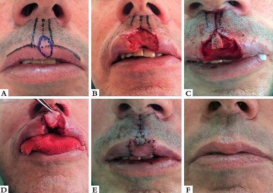 Retalho V-Y associado a enxerto de Burow. A - Carcinoma basocelular
							mal delimitado. B - Ferida operat&oacute;ria envolvendo filtrum e vermelh&atilde;o. C
							- Enxerto de Burow fixado para restaurar o filtrum. D - Retalho V-Y de
							mucosa sendo deslocado para restaurar o vermelh&atilde;o. E - P&oacute;s-operat&oacute;rio
							imediato. F - P&oacute;s-operat&oacute;rio tardio. Notar adequada recria&ccedil;&atilde;o do arco do
							cupido.