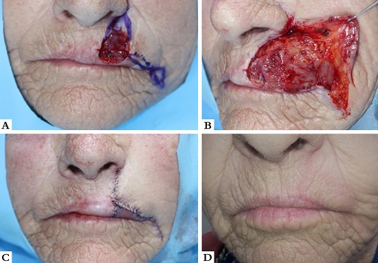 Retalho de avan&ccedil;o lateral. A - Ferida operat&oacute;ria envolvendo LCS
							esquerdo e vermelh&atilde;o ap&oacute;s remo&ccedil;&atilde;o de fibroxantoma at&iacute;pico. Desenho do
							retalho ilustrado. B - Retalho descolado. Na regi&atilde;o do LCS, o plano de
							deslocamento &eacute; supramuscular, enquanto na regi&atilde;o al&eacute;m do SNG, &eacute; no
							tecido subcut&acirc;neo. Deve-se atentar para n&atilde;o aprofundar o descolamento
							nessa regi&atilde;o. C - P&oacute;s-operat&oacute;rio imediato. O tri&acirc;ngulo de Burow inferior
							foi removido em tr&ecirc;s por&ccedil;&otilde;es: inferiormente &agrave; ferida; crescente no
							retalho e no sulco l&aacute;bio mentoniano. D - P&oacute;s-operat&oacute;rio de quatro
							meses