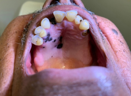 Aspecto macrosc&oacute;pico de les&atilde;o em gengiva &agrave; direita