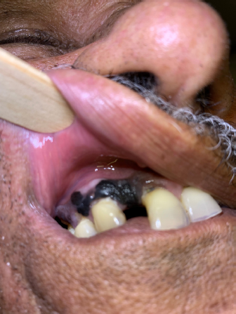 Aspecto macrosc&oacute;pico de les&otilde;es em palato