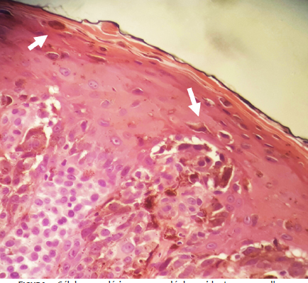 C&eacute;lulas neopl&aacute;sicas com nucl&eacute;olos evidentes e vermelhos. Notar c&eacute;lulas
                        neopl&aacute;sicas infiltrando a epiderme (setas) (Hematoxilina & eosina,
                        aumento de 400x)