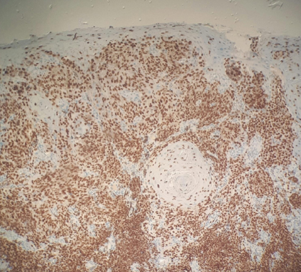 C&eacute;lulas neopl&aacute;sicas com citoplasma marcado com melan-A (aumento de
                        100x)