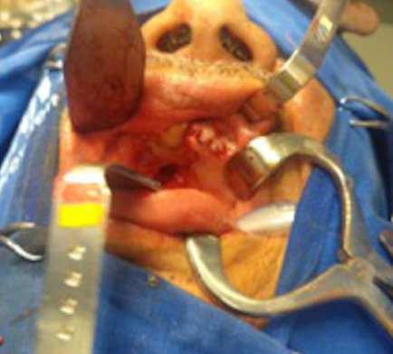 Intraoperat&oacute;rio ap&oacute;s ressec&ccedil;&atilde;o do tumor