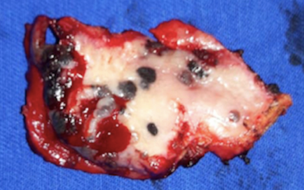 Pe&ccedil;a cir&uacute;rgica ressecada