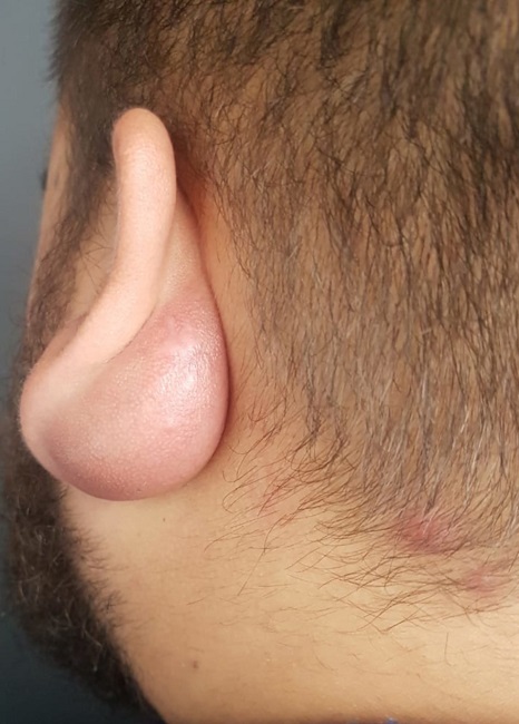 Nodulação estendendo-se para região posterior