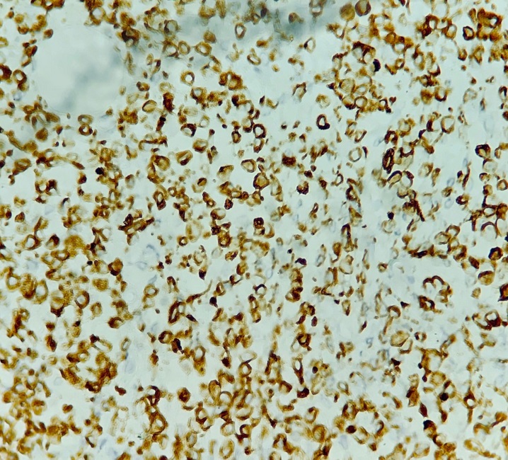 Miogenina positivo - Clone D 33 (40x)