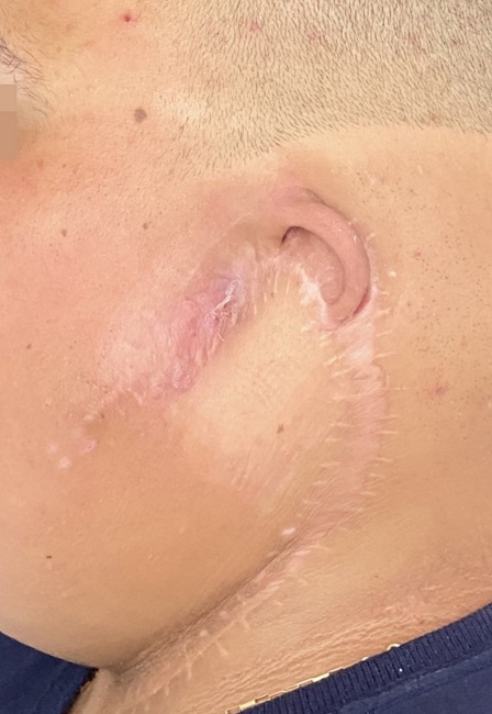 Pós operatório de ressecção tumoral e linfadenectomia cervical
