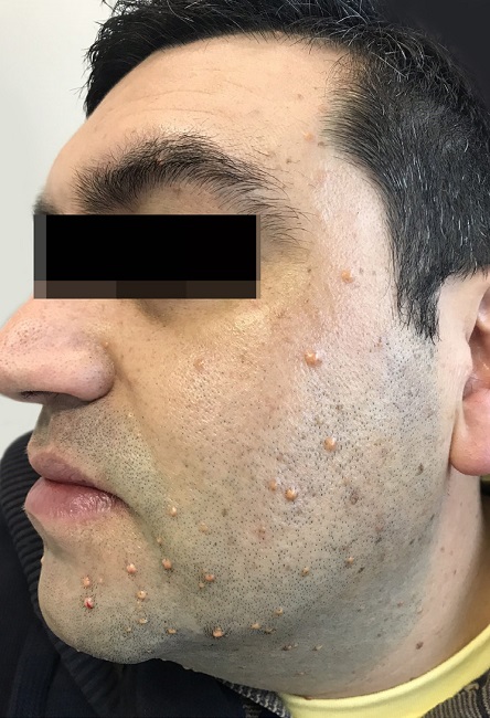 Observação de diversas pápulas normocrômicas a levemente amareladas, firmes e brilhantes