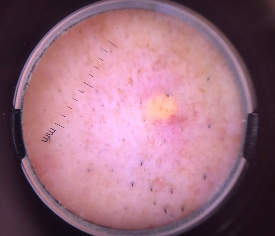 À dermatoscopia, pápula amarelada com halo discretamente eritematoso e vasos na periferia da lesão