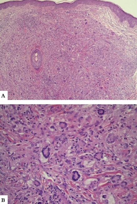 Pele exibindo proliferação celular dérmica com presença de numerosos histiócitos espumosos e gigantocelulares - células de Touton, compatíveis com xantogranuloma. Aumentos 10x (imagem A) e 40x (imagem B)