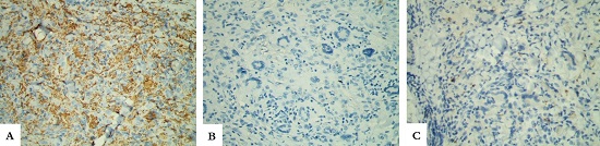 Exame imuno-histoquímico com expressão de CD68 observado na imagem A, ausência de expressão dos marcadores de células de Langerhans S100 e CD1a observados, respectivamente, nas imagens B e C