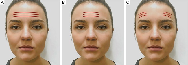 Illustration of frontal contraction patterns
