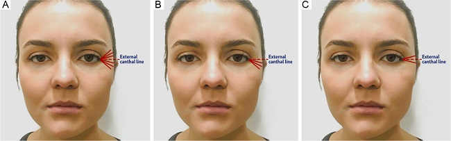 Illustration of periorbital contraction patterns
