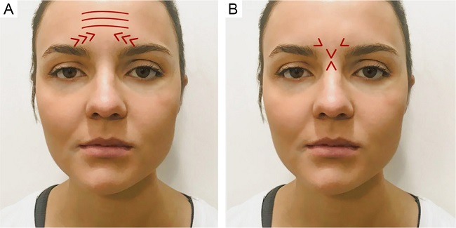 Illustration of glabelar contraction patterns: omega and inverted
                            omega patterns