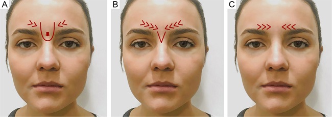 Illustration of glabellar contraction patterns - U, V and converging
                            arrow patterns