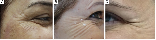 Clinical illustration of periocular contraction patterns. A
                                - type 1 pattern, also known as full pattern; B
                                - type 2 pattern, also called lower eyelid/upper cheeks
                            pattern and C - type 3 pattern, representing only
                            midlines