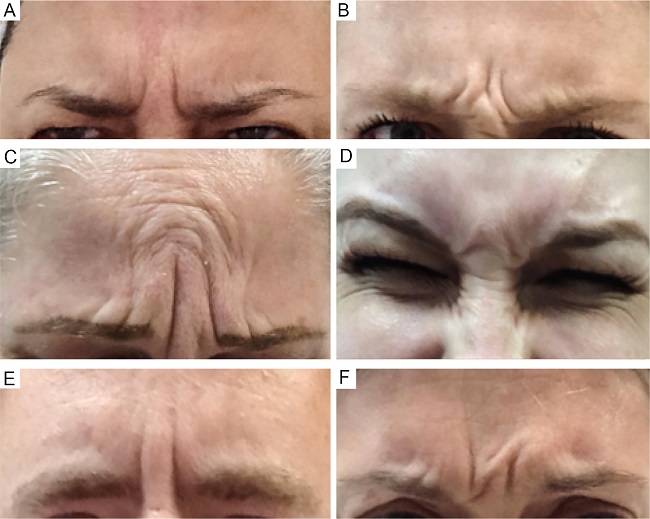 Clinical illustration of glabellar contraction patterns. A
                                - U pattern; B - pattern V; C -
                            omega pattern; D - inverted omega pattern; E-
                            converging arrows pattern and F - atypical pattern