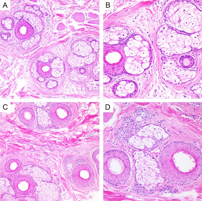 Histopathological study of scalp before (A and
                                B) and after microneedling treatment (C
                            and D). A. Two hair units with three follicles and
                            sebaceous glands. H.E. stain. Original magnification 10x. B. One of the
                            follicles is a vellus hair. H.E. stain. Original magnification 20x.
                                C. Three hair units with five follicles and sebaceous
                            glands. H.E. stain. Original magnification 10x. D. Only
                            terminal hairs are seen, and some lymphocytes are noted in the adjacent
                            dermis. H.E. stain. Original magnification 20x. No significant changes
                            in average hair count and hair diameter before and after the procedure
                            were noticed.