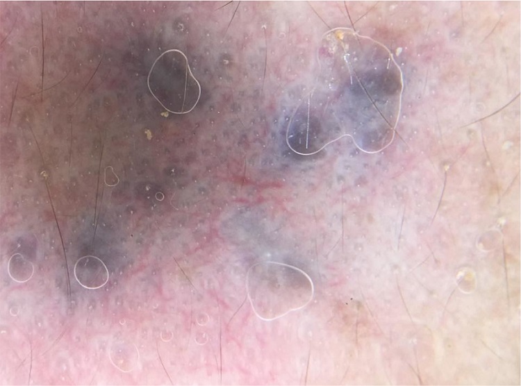 Non-polarized light dermoscopy: homogeneous pigmented lesions with a blue-gray hue and absence of structures, interspersed with areas of healthy, slightly erythematous skin with intermingled telangiectasia.