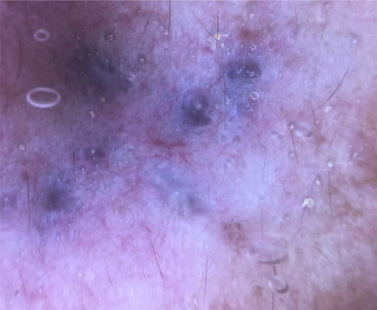 Polarized light dermoscopy: blue-gray pigmented lesions with areas without structures plus bright white scar-patterned lines and smudges.