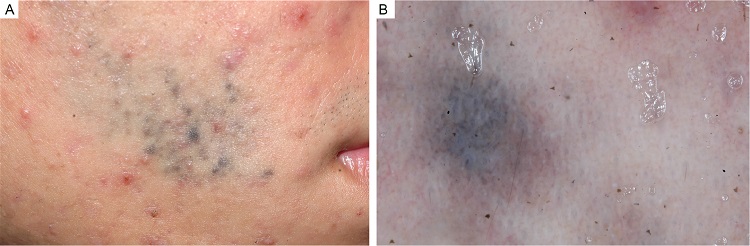 A - Blue-black macula measuring 4 cm by 2 cm in the right buccinator region. B - Dermoscopy (non-polarized light): homogeneous blue-gray pigmentation, without structures, interspersed with areas of erythematous healthy skin.