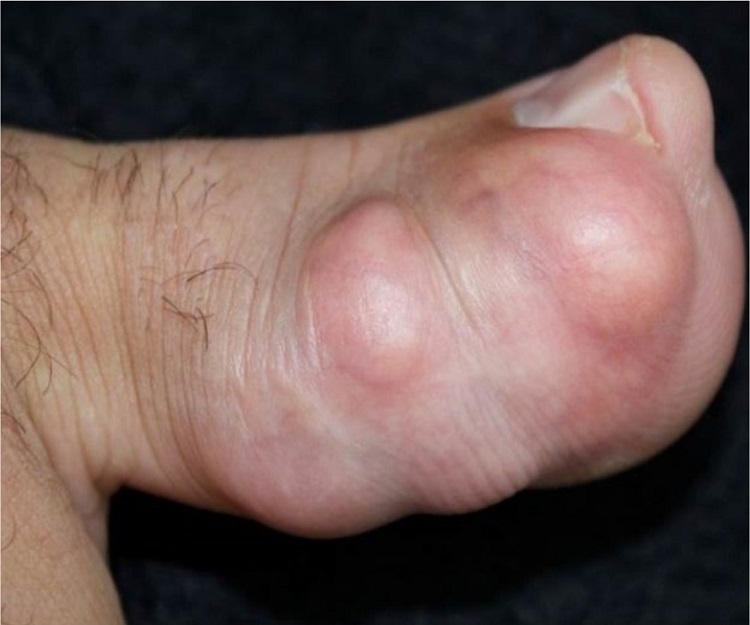 Low-grade fibromyxoid sarcoma. Tumor in the right thumb, with exposure of telangiectasia and multilobulated appearance