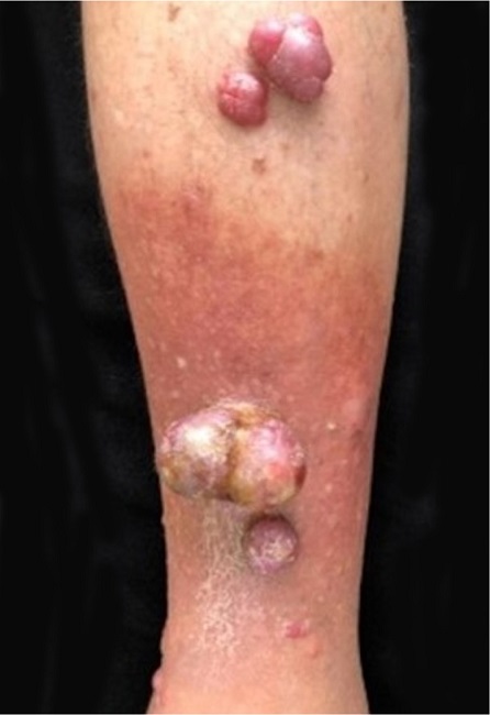 Merkel cell carcinoma: multiple primary skin lesions on the lower limb