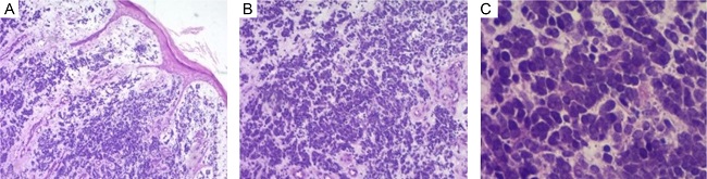 Histopathology of Merkel cell carcinoma. A - Atrophic epidermis; in the dermis, proliferation of small, hyperchromatic cells is observed, extending to the hypodermis (Hematoxylin & eosin, 40x). B - Detail of small cells arranged singly or in chordal arrangements or rosettes (Hematoxylin & eosin, 100x). C - Nuclei are oval-shaped, similar in size to a mature lymphocyte, with chromatin in a &ldquo;salt-and-pepper&rdquo; pattern, with nuclear molding, apoptotic bodies, and mitotic figures (Hematoxylin & eosin, 400x)