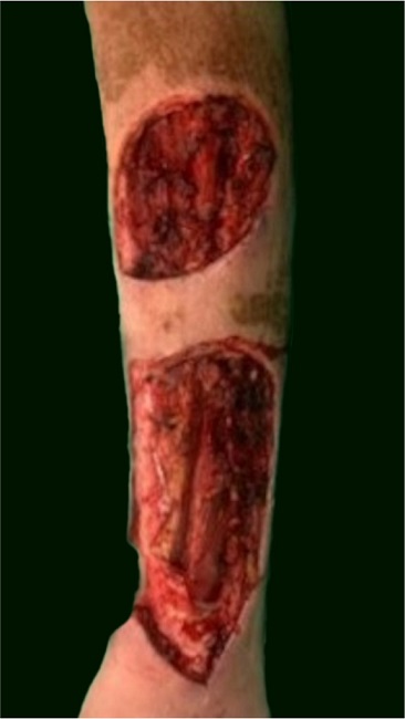 Multiple cutaneous Merkel cell carcinoma: surgical approach.