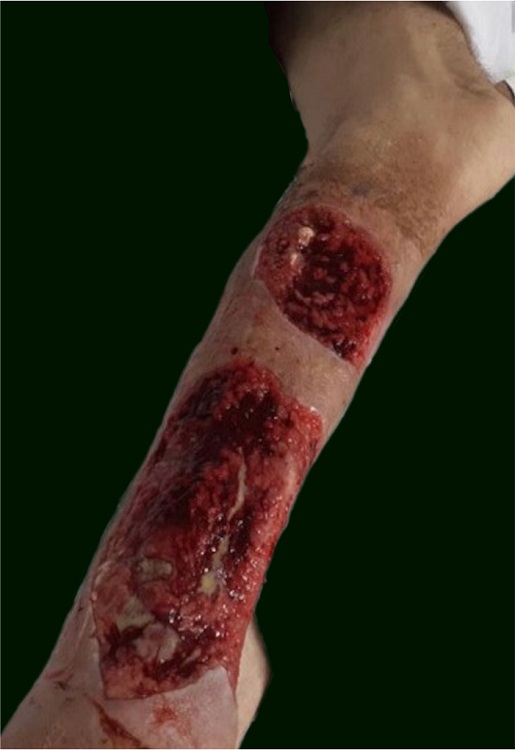 Multiple cutaneous Merkel cell carcinoma: 15th postoperative day