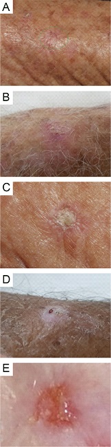 * A - Grade 1 erythema, Grade 1 infiltration, Grade 1 hyperkeratosis, Grade 1 exulceration. B - Grade 1 erythema, Grade 1 infiltration, Grade 2 hyperkeratosis, Grade 1 ulceration. C - Grade 1 erythema, Grade 2 infiltration, Grade 3 hyperkeratosis, Grade 1 exulceration. D - Grade 1 erythema, Grade 2 infiltration, Grade 3 hyperkeratosis, Grade 1 exulceration (bleeding area is due to anesthetic injection). E - Grade 2 erythema, grade 1 infiltration, grade 1 hyperkeratosis, grade 2 exulceration.