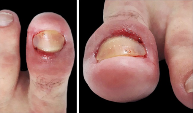 Dermatological examination of the left hallux shows voluminous granulation tissue at the proximal nail border - longitudinal and frontal planes
