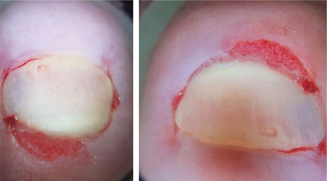 Dermoscopy of the nail plate of the left hallux, demonstrating voluminous granulation tissue under the proximal nail border