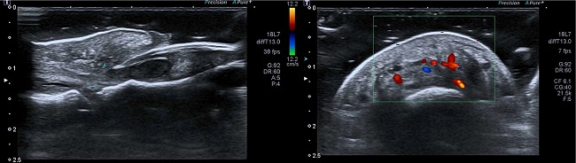 Doppler ultrasound of the left hallux, in lateral and frontal sections, showing overlapping nail plates below the proximal nail border and increased blood flow in the granulation tissue region