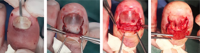 Sequence of the operative act: initial detachment of the first plate, folding of the proximal nail fold, exposure, and removal of granulation tissue under the fold, folded plate, and visualization of the second dystrophic plate under the first
