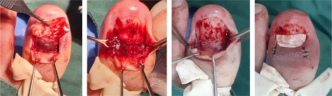 Sequence of the operative act: detachment of the second plate and visualization of abundant granulation tissue in-depth, removal of the granulomatous material, removal of the third fragmented and dystrophic plate, removal of devitalized tissues on the bed, cleaning, and washing of the cavity, placement of a latex, proximal fold repositioning, suture