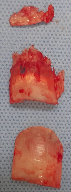 Nail blades excised during nail surgery for retronychia in the left hallux*