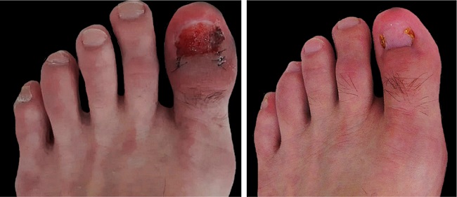 Postoperative dermatological examination at 14 days and after 60 days, in sequence