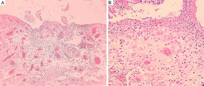 Histopathological examination of the excised granulation tissue, showing neutrophilic infiltrate, extravasation of red blood cells, and fibrin deposits in the dermis: Hematoxylin & eosin staining 100x A and 400x B