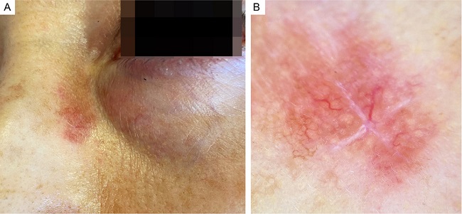 A - Nasal lesion in an erythematous-orange plaque with an &ldquo;apple jelly&rdquo; appearance. B - Dermoscopy showing telangiectatic vessels, on an erythematous-orange base, with hypochromic linear structures and central scar from a previous biopsy